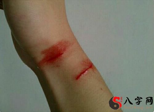 梦见手臂受伤流血